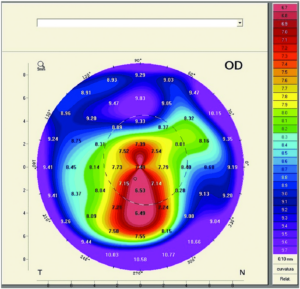 New Methods – Topography, Pachymetry Map, Pentacam – The Keratoconus